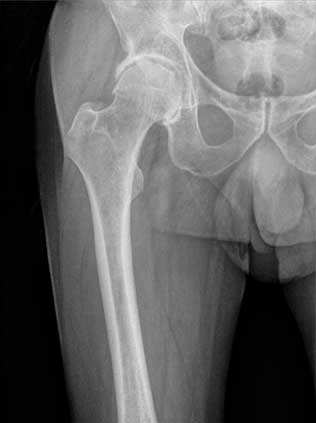 PTA-protesi-totale-anca-dx-pret