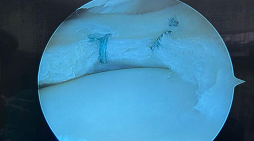 Lesioni meniscali: quando e perché preservare il menisco